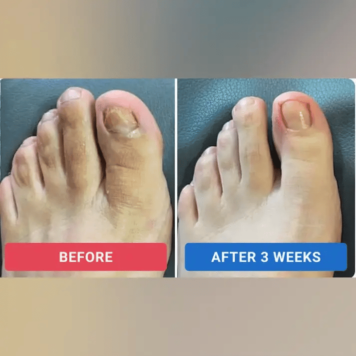 FungGone – Nail Repair Patches