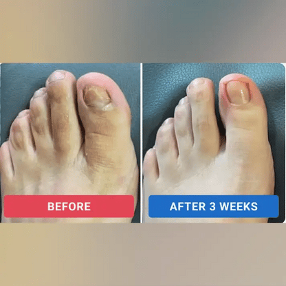 FungGone – Nail Repair Patches